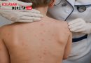 Waspada Campak, Kenali Gejala Awal hingga Tanda Berbahaya untuk Deteksi Dini